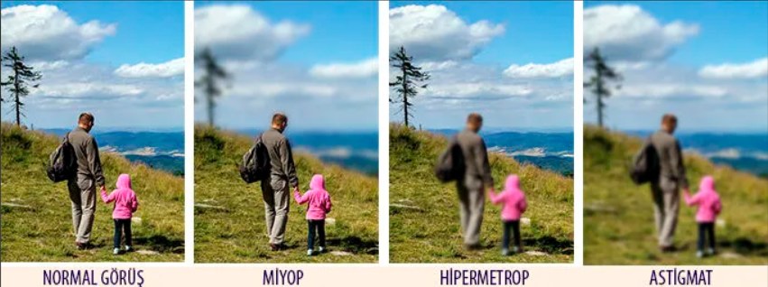 Normal görüş, miyop, hipermetrop ve astigmat görüş karşılaştırması