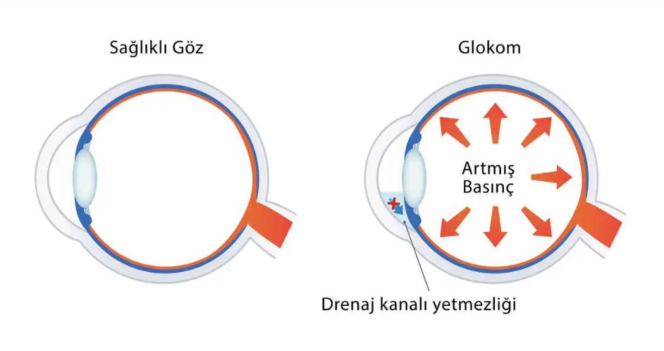 Sağlıklı göz ve glokomda drenaj