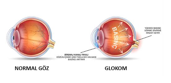 Glokom (Göz Tansiyonu)