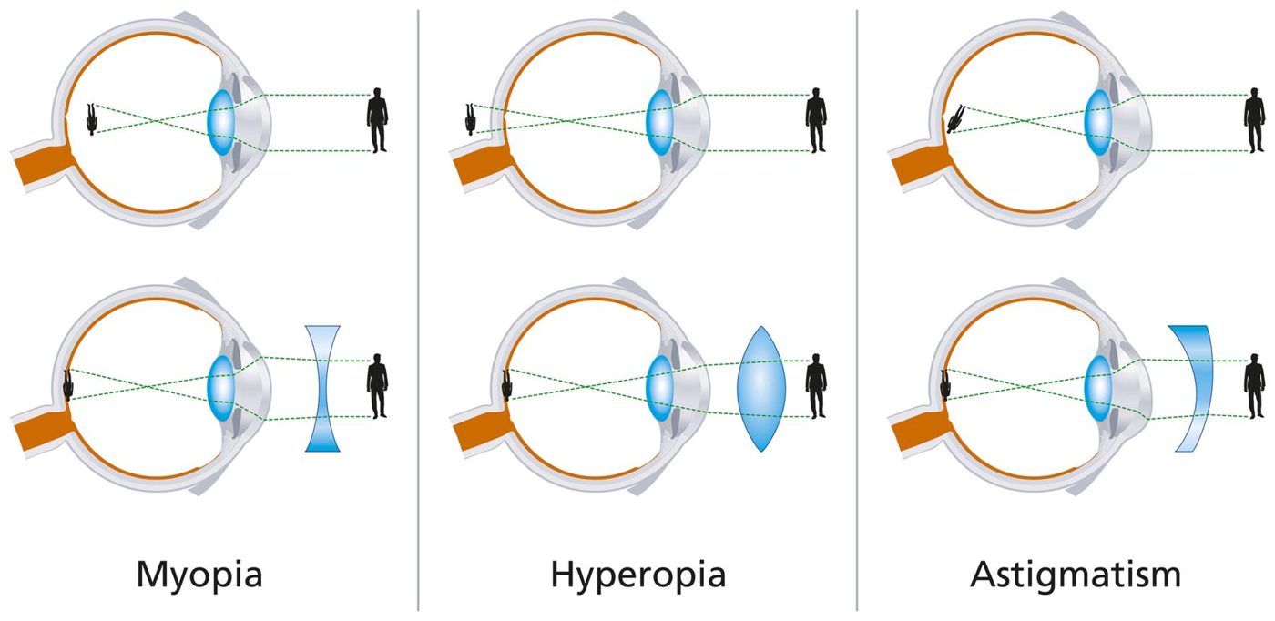 Miyopi, hipermetropi ve astigmatizmada ışığın odaklanması